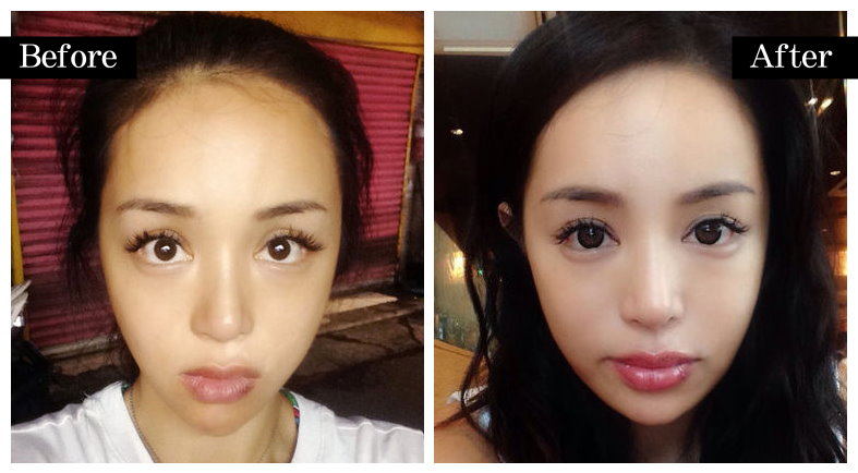 “童颜针”代理权争议未决又起波澜，*ST苏吴子公司吴中美学苏诉爱美客等商标侵权纠纷获立案