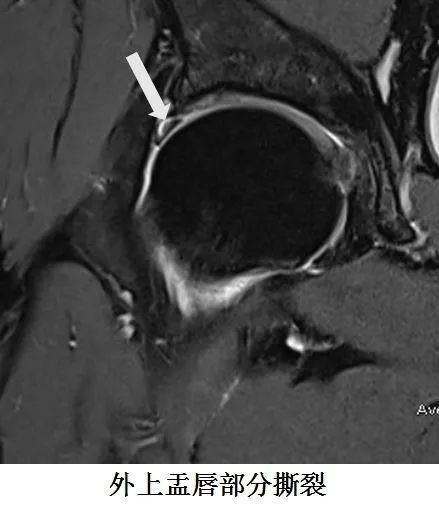 春立医疗获得发明专利授权:“一种延伸固定的用于髋臼严重骨缺损重建的多孔金属垫块”